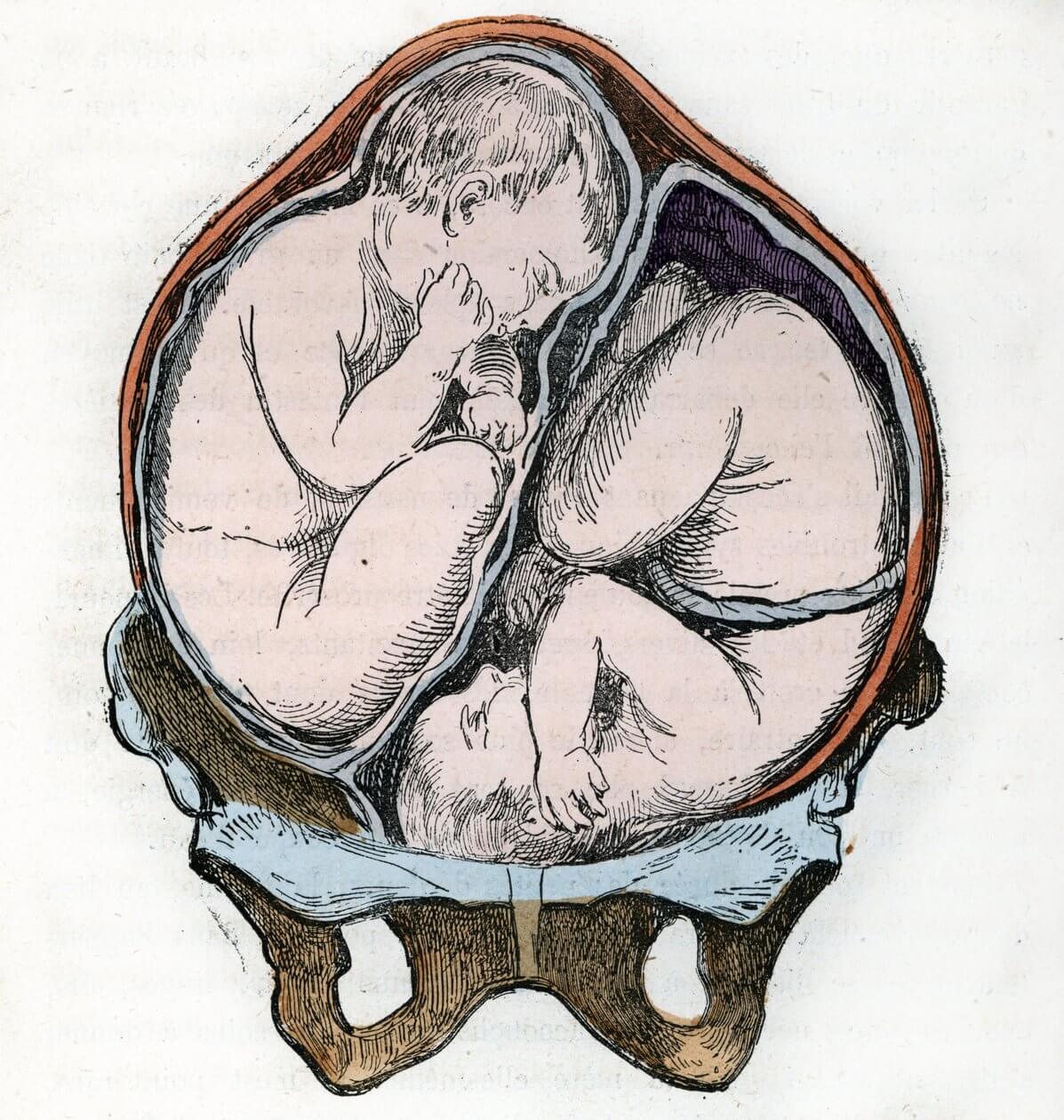 Engraving art work showing a womb with twins.